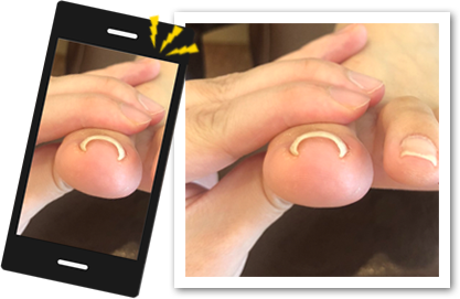 スマホで爪を撮影画像